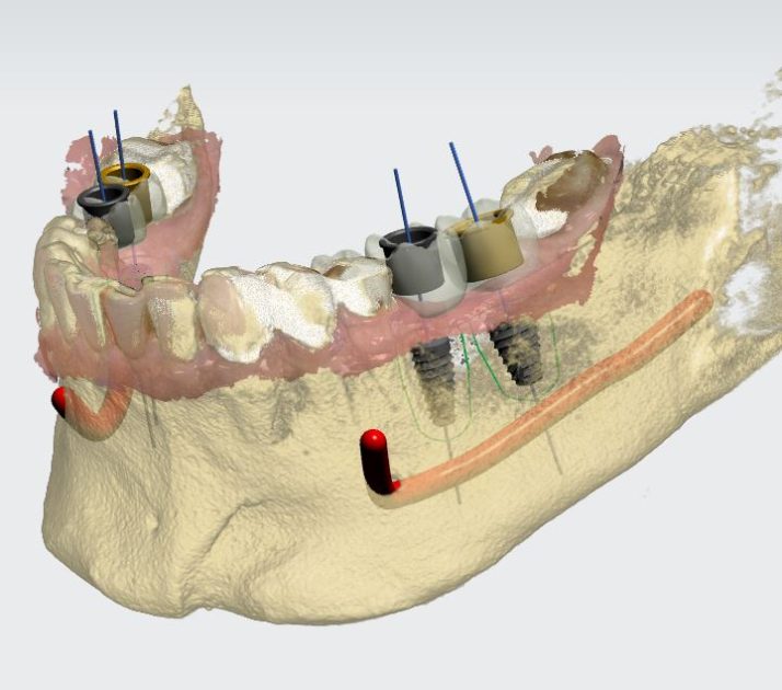 Guided surgery Thumbnail