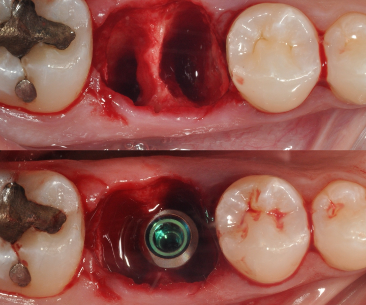 Immediate implant extraction and placement